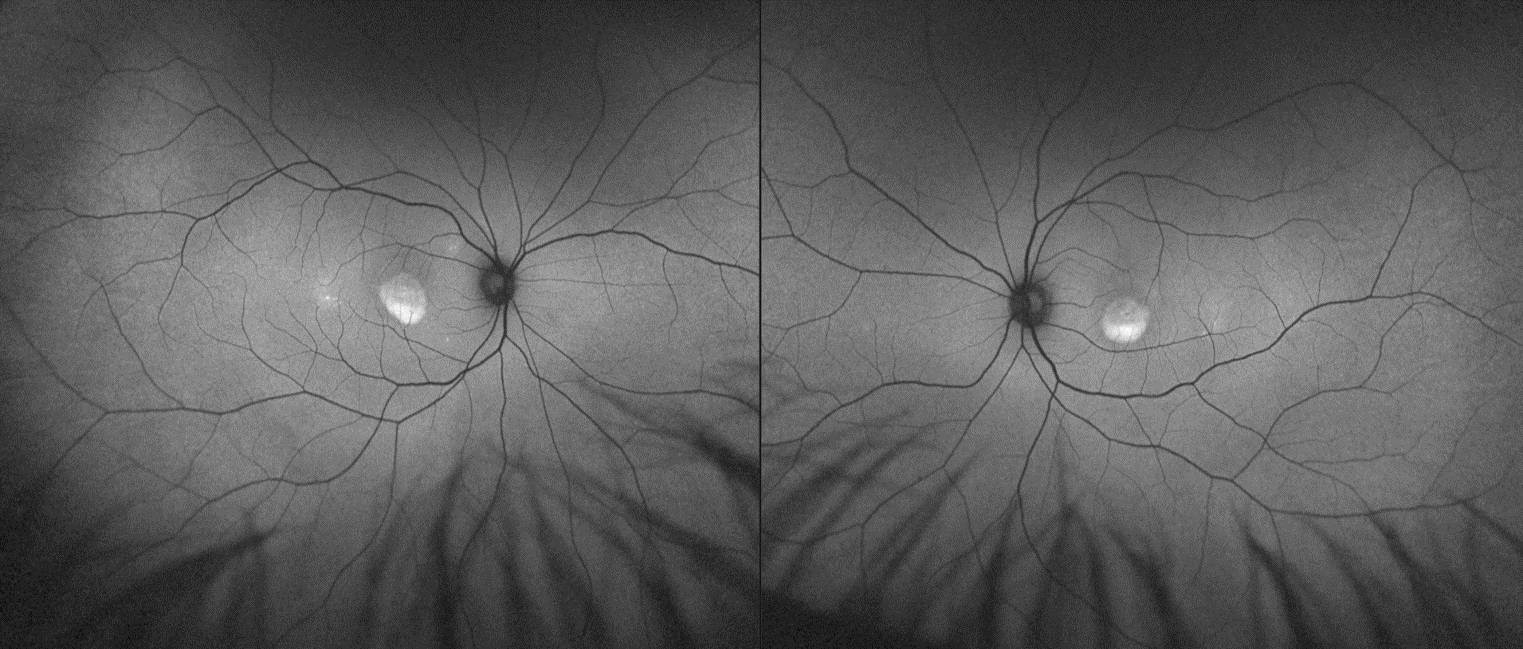 Blog Adult Onset Vitelliform Dystrophy – Prime Retina Eye Care Centre